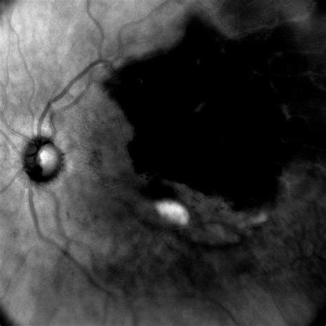 Branch Retinal Vein Occlusion With Macular Edema Retina Image Bank