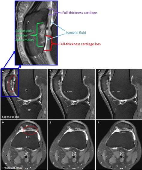 Comparison Of Knee Articular Cartilage Defect Size Between Measurements