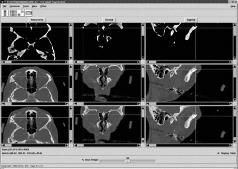 Point To Point Computer Assisted Navigation For Precise Transfer Of