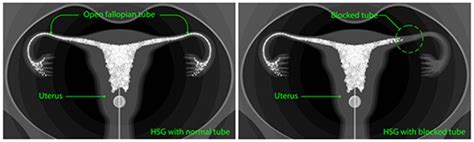 What Is Hysterosalpingography HSG HSG Procedure HayatMedTour