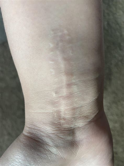 What would you get/design for this wrist with scar? : r/TattooDesigns