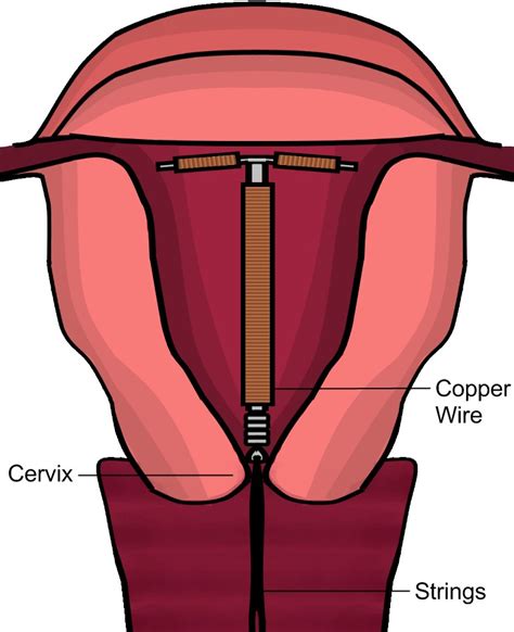 Iud With Copper