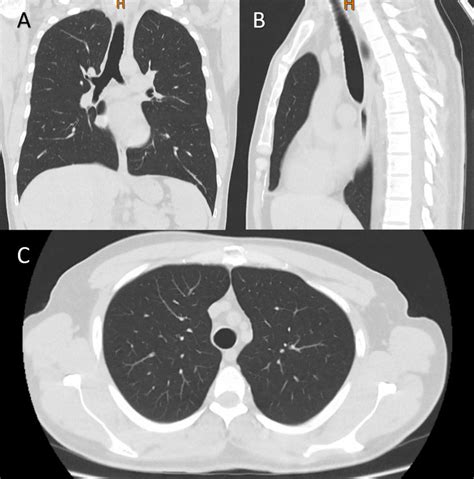 The Computed Tomography Scan One Month Following Surgical Management Of