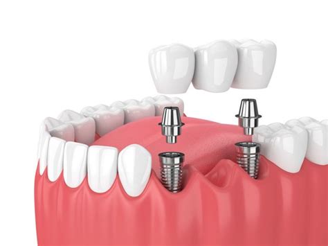 Multiple Dental Implants in Virginia Beach, VA