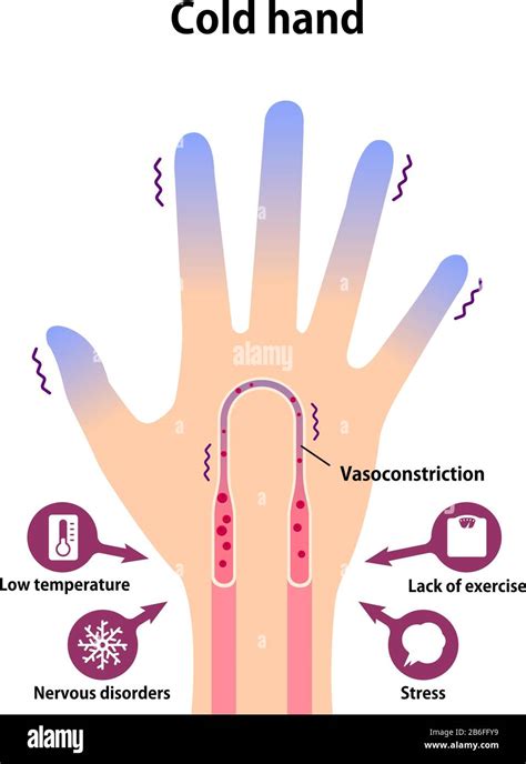 Poor Circulation High Resolution Stock Photography And Images Alamy