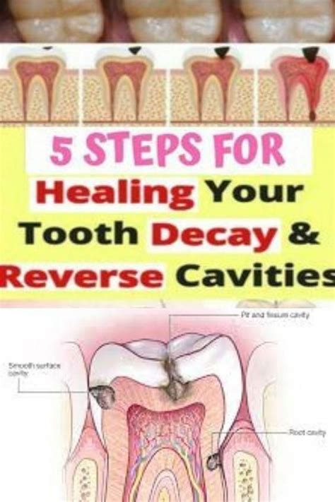 Get Rid Of Cavities And Tooth Decay Emily Smith Artofit