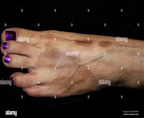 Pigmented purpuric dermatosis Schamberg Stock Photo - Alamy