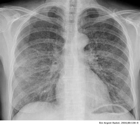 Neumonía por Hongos Cómo se diagnostica