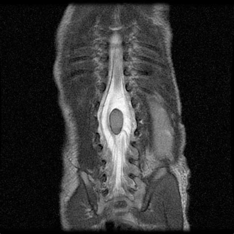 Diastematomyelia - wikidoc