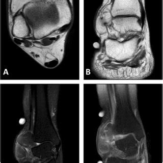 Clinical photograph showing a swelling over the lateral malleolus of ...