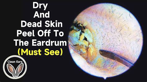 Dry And Dead Skin Peel Off To The Eardrum 乾燥して死んだ皮膚が鼓膜まで剥がれる Youtube