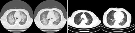 Laboratory Findings Before And At Diagnose Of Pcp Pcp Pneumocystis Download Scientific