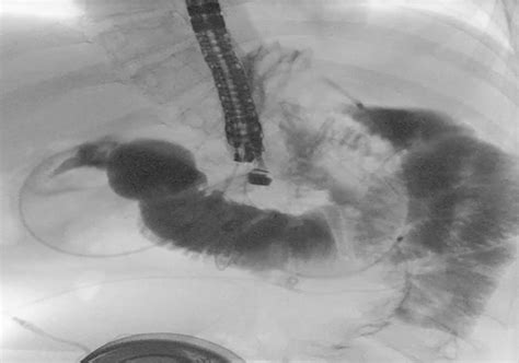 Endoscopic Ultrasound Guided Gastrojejunostomy With Lumen Apposing