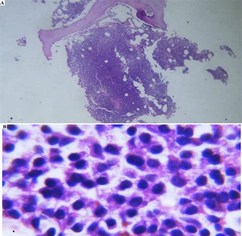 Bone Marrow Biopsy A Bone Marrow Biopsy Shows Hypercellularity B