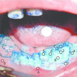 Case 1. Histological diagnosis: verrucous carcinoma. | Download ...