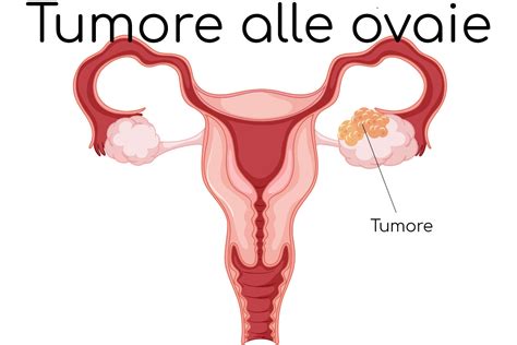 Tumore Alle Ovaie Sintomi Sopravvivenza E Cura Valori Normali