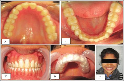 Follow Up Clinical Images After One Month Of Retention Phase Showing Download Scientific