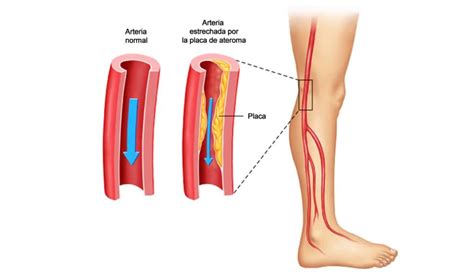 Infórmate Sobre La Enfermedad Arterial Periférica Y Su Tratamiento