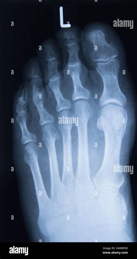 Radiograf A Normal Del Pie Diagn Stico M Dico Traumatolog A Y