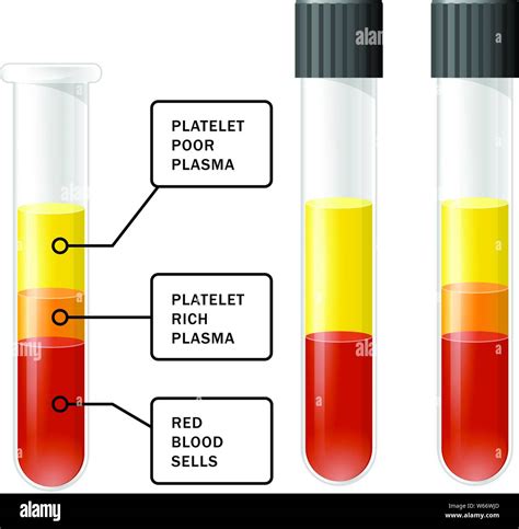 Blood After Separation Of Platelets In The Centrifuge In Test Tube Prp