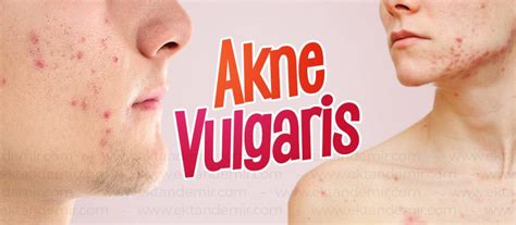 Akne Vulgaris Sivilce Tanı ve Tedavisi Dermatolog Dr Ektan Demir