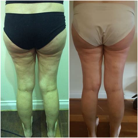 Velashape Before And After Thighs