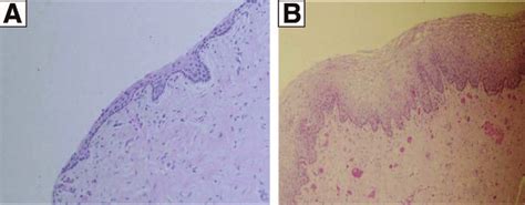 Histologic Appearance Of Atrophic And Mature Vaginal Epithelium A