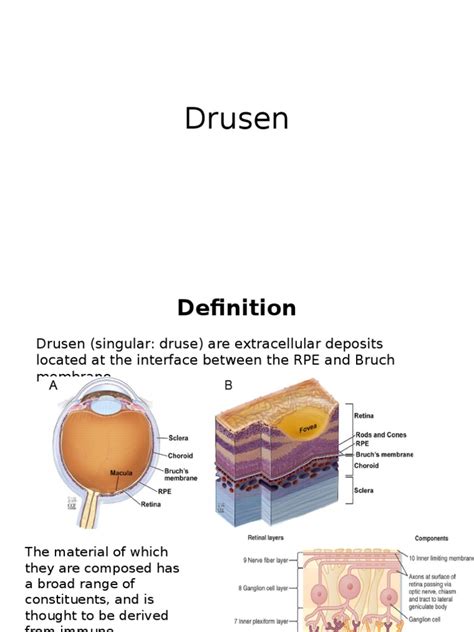 Drusen | Retina | Ophthalmology