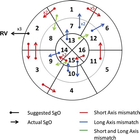 A Qrs Axisbased Algorithm To Identify The Origin Of Scar Related