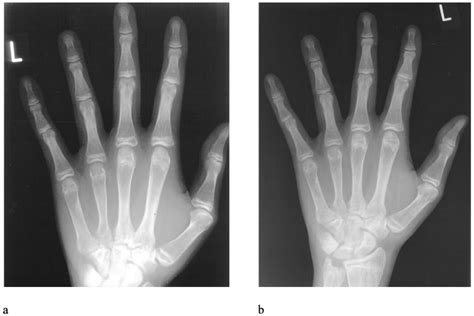 X Ray Films Of The Development Of The Epiphyseal Closure Left Hand