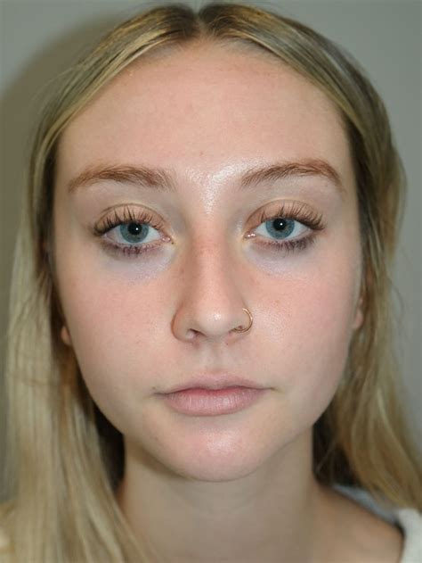 Rhinoplasty Before And After Grover Aesthetics