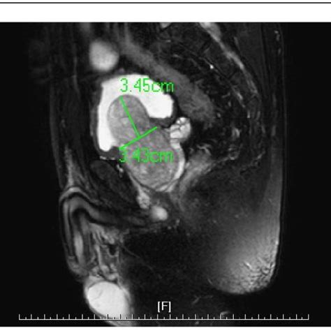 Measurement Of Intravesical Protruding Prostate In Sagittal Plane Of Mri Download Scientific