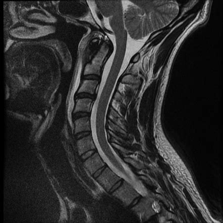 Longus Colli Calcific Tendinitis Radiology Case Radiopaedia Org