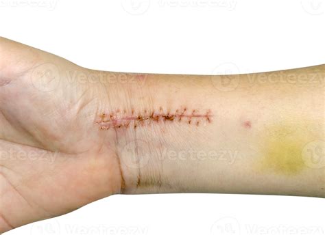 Closeup Stitches From Broken Arm Surgery And Bruised Isolated 22786593 Png