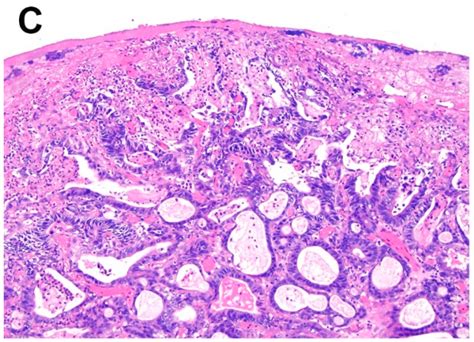 Adenocarcinoma Esophagus Histology