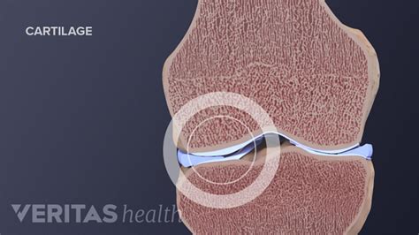 Knee Cartilage Repair Regeneration And Replacement