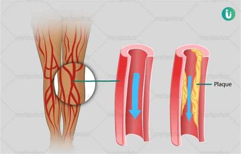 Peripheral Artery Disease Pad Symptoms Causes Treatment Medicine