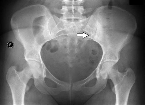 Sacroiliac Joint Erosion