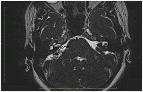 Axial T2 weighted MRI showing facial nerve (black arrow) and ...