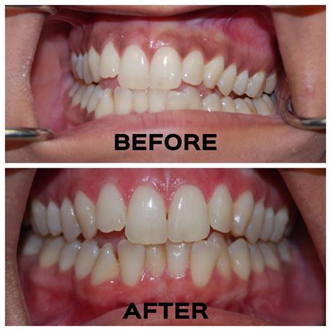 Black Stains On Teeth Near Gums Teethwalls 9DA