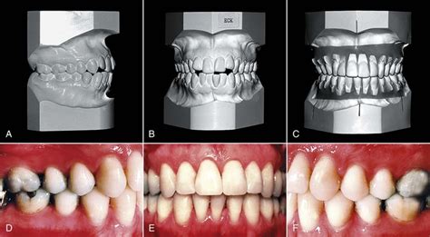 26 Interrelationship Of Orthodontics With Periodontics And Restorative