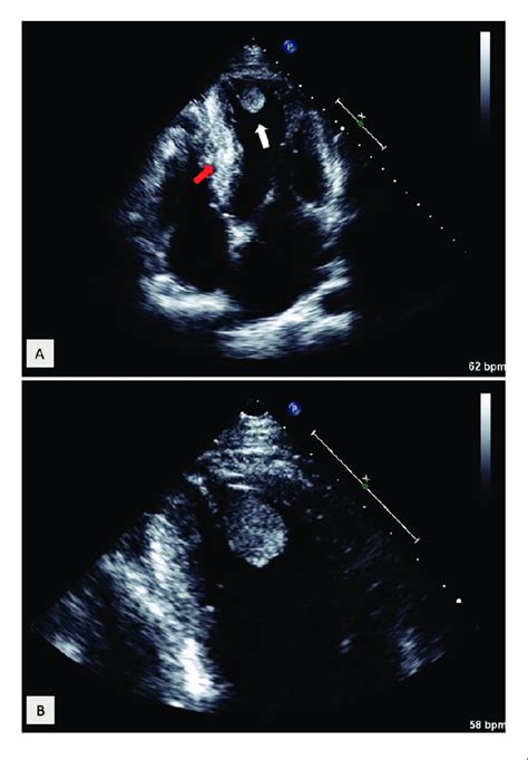 Transthoracic Echocardiography Raising The Suspicion Of Hypertrophic