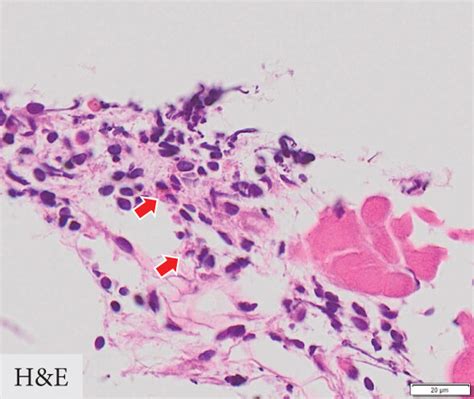 Right Ventricular Myocardial Biopsy Specimen A Extensive