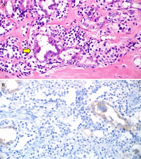 Mixed Medullary And Papillary Thyroid Carcinoma A The Papillary