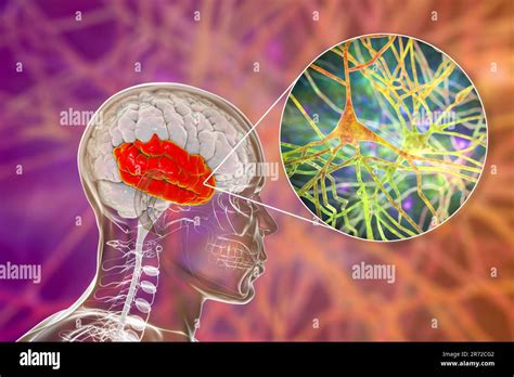 Human Brain With Highlighted Temporal Lobe And Close Up View Of Neurons