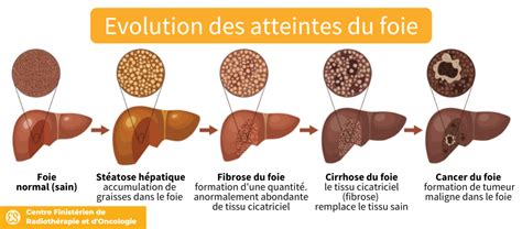 Cancer Du Foie Symptômes Espérance De Vie Oncologie Brest