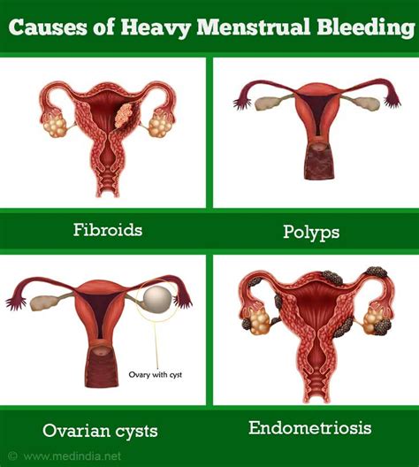 What Causes Blood Clots During Your Menstrual Cycle at Grace Sandy blog