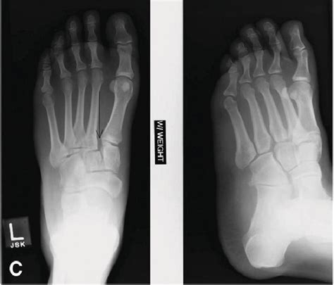 16 Weightbearing Radiographs Successfully Visualizing A Lisfranc Download Scientific Diagram