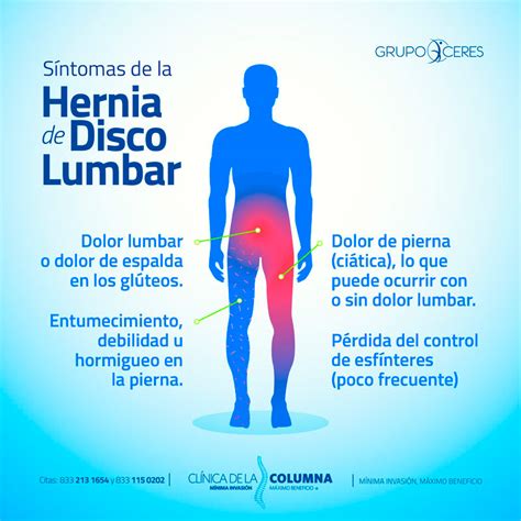 Hernia de Disco Dr Miguel Ángel Santana Reyna