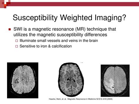 Ppt Susceptibility Weighted Imaging Swi Powerpoint Presentation